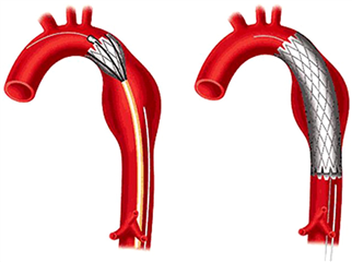 Endovascular treatment of descending aortic aneurysm